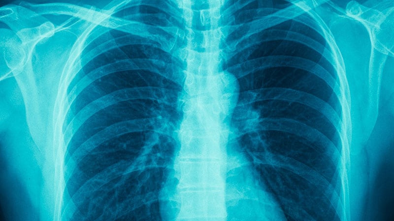 Steroids May Lower Death Risk in CAP